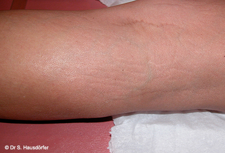 laser fraxel vergetures laser fraxel vergetures