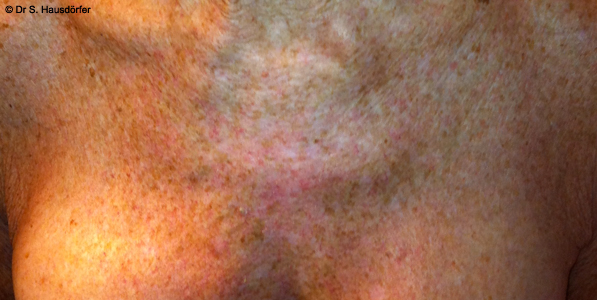 comment soigner une keratose actinique