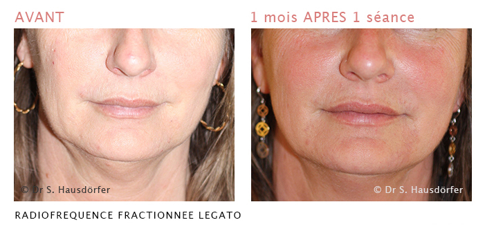 Cliquez pour plus d'infos Radiofrequence fractionnee LEGATO